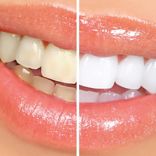 blanqueamiento-dentar-1-clinica-amaranta1