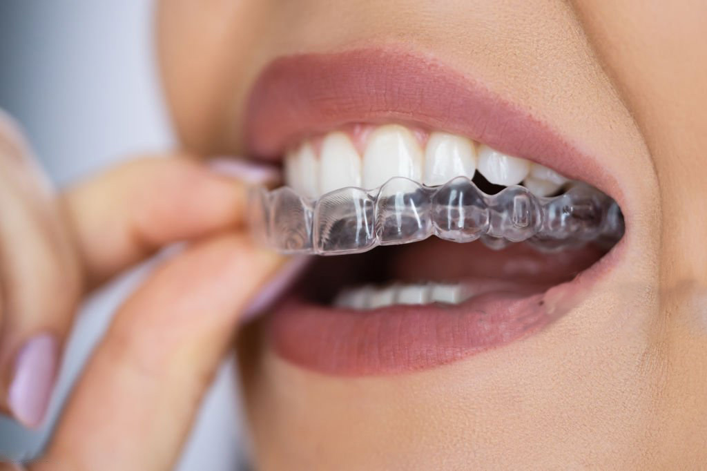 Colocación de alineador dental transparente en primeros planos de una sonrisa cuidada. Leyenda: